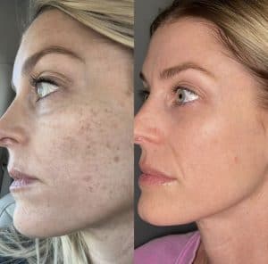Laser Treatments Before and After Laser Treatments Before and After