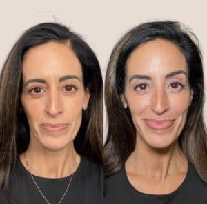 Sculptra Before and After Sculptra Before and After