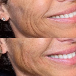 Dermal filler facial rejuvenation for wrinkle reduction and skin tightening.