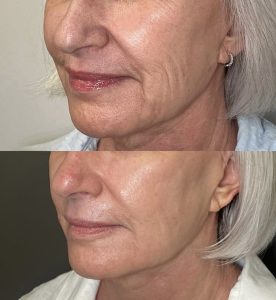 Reduced fine lines and wrinkles after aesthetic treatment at Skin Savvy Aesthetics Med Spa.