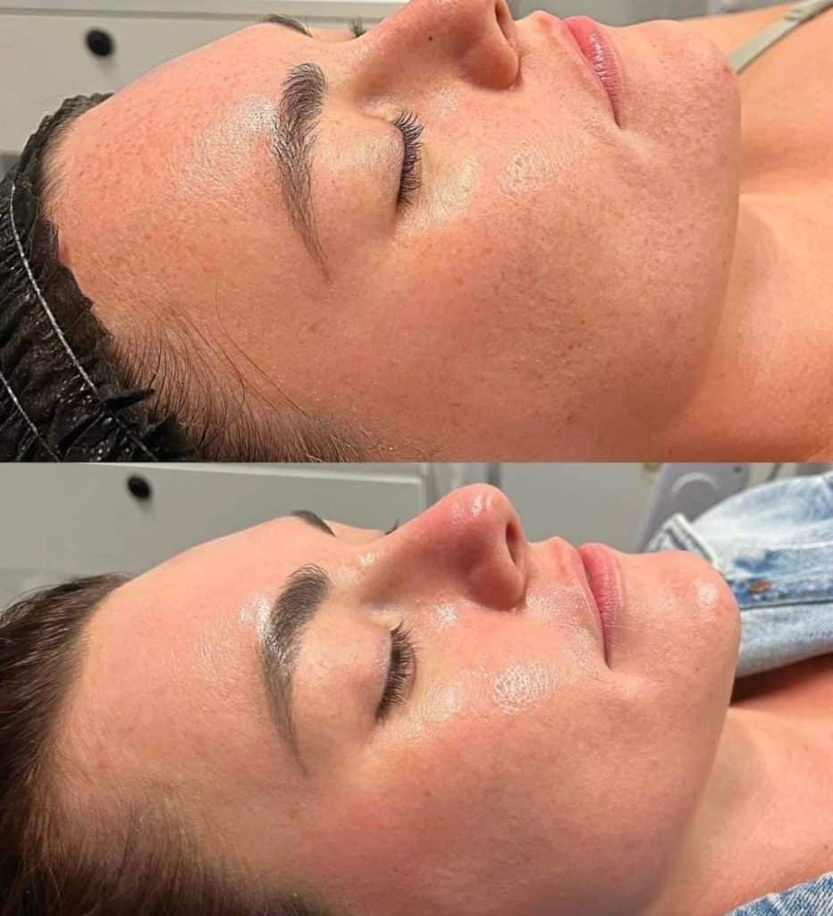 Clear skin transformation after facial treatment at Skin Savvy Aesthetics Med Spa.