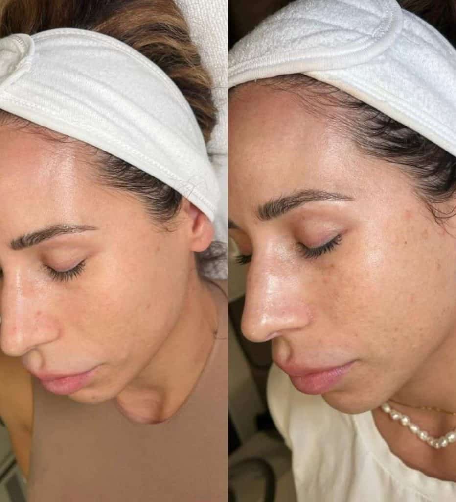 Clear skin transformation with Skin Savvy Aesthetics Med Spa skincare treatment.
