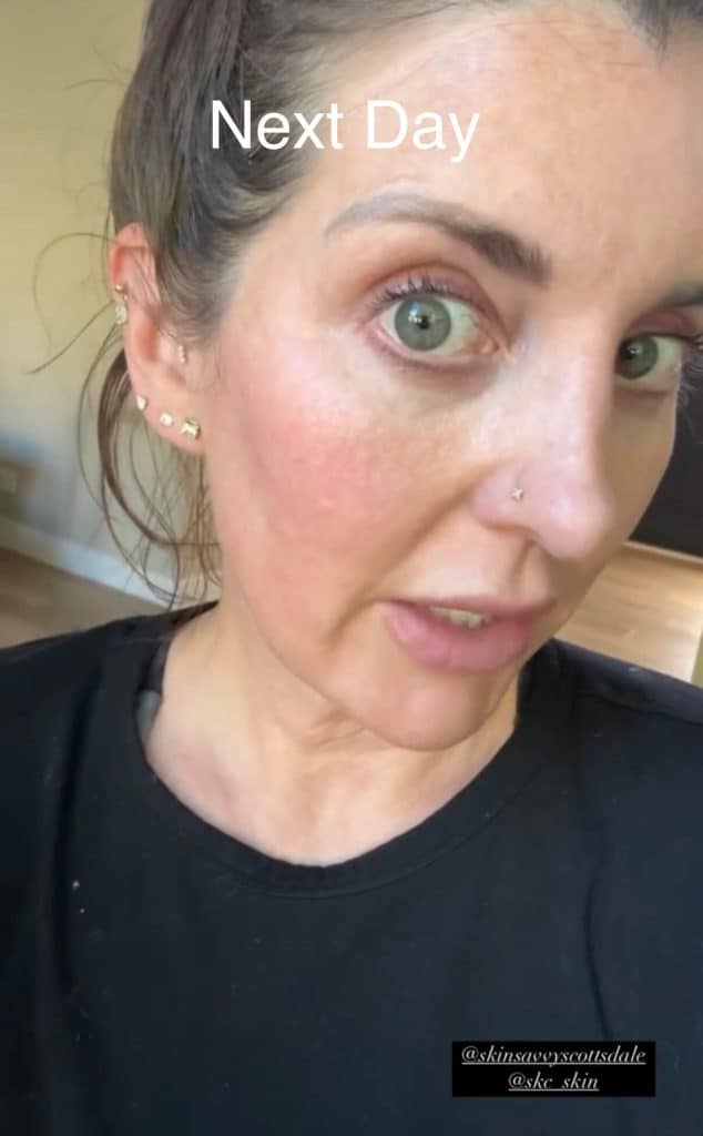 SkinGlow Laser Peel Recovery Next Day