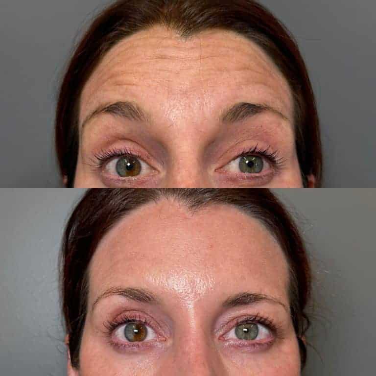 Botox forehead treatment Scottsdale AZ before and after reducing horizontal forehead lines