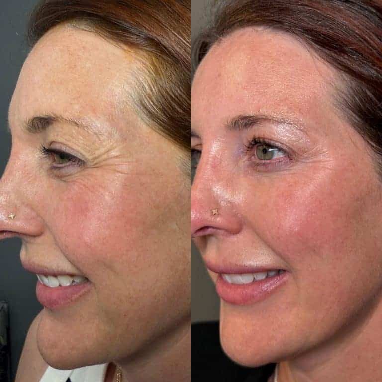 Botox for crow’s feet Scottsdale AZ before and after reducing eye wrinkles